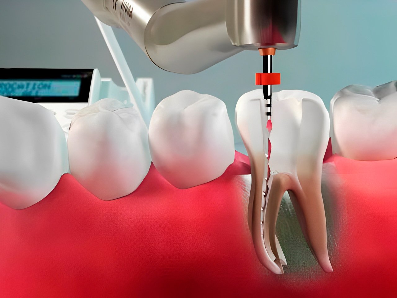 Endodontia-Mecanizada-(10)
